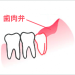 歯肉弁