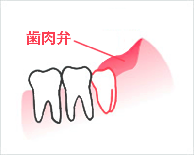名医監修 口臭の原因は親知らずかも 親知らず抜歯と臭いの関係性 歯科医師ブログ