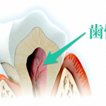 歯髄腔と天気の深い関係