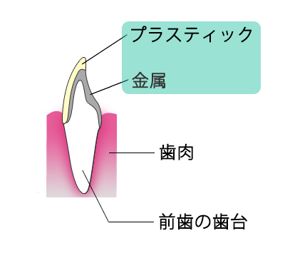 保険適用可能な前歯の被せ物(クラウン)