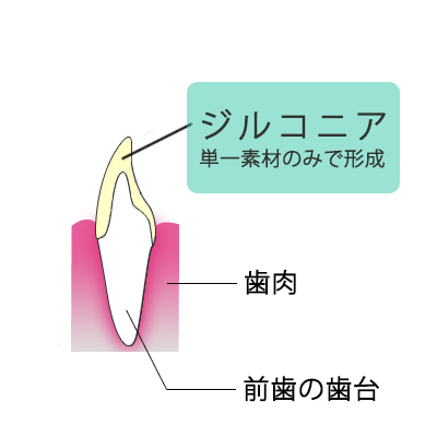 自由診療で利用可能な前歯の被せ物(クラウン)